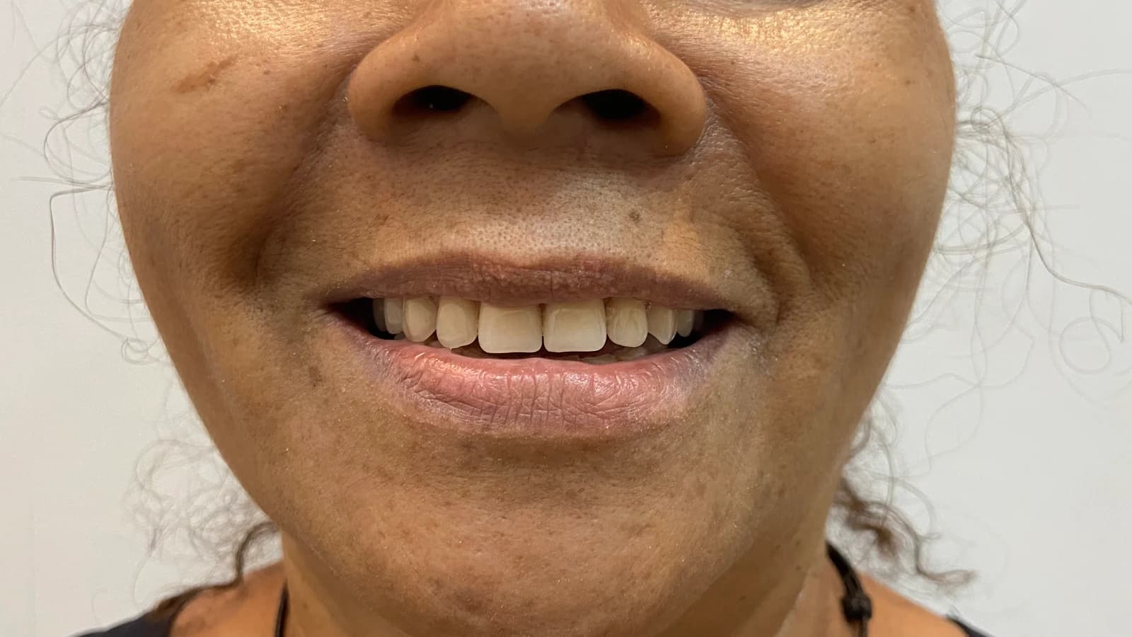 Sorriso depois do tratamento de facetas dentárias
