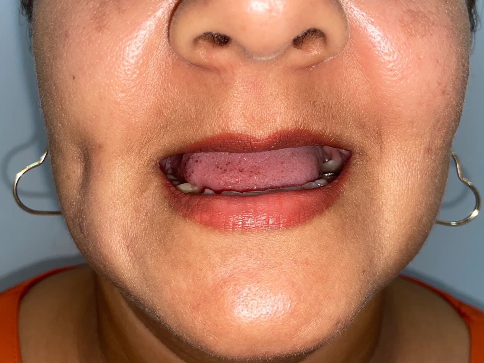 Sorriso antes do tratamento de facetas dentárias